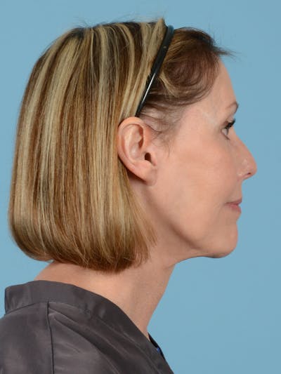 Neck Lift Before & After Gallery - Patient 113503563 - Image 8