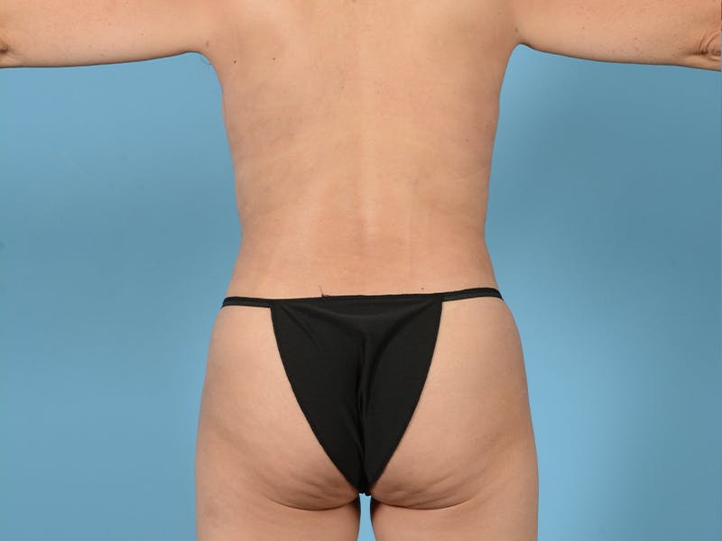 Tummy Tuck Before & After Gallery - Patient 113503689 - Image 8