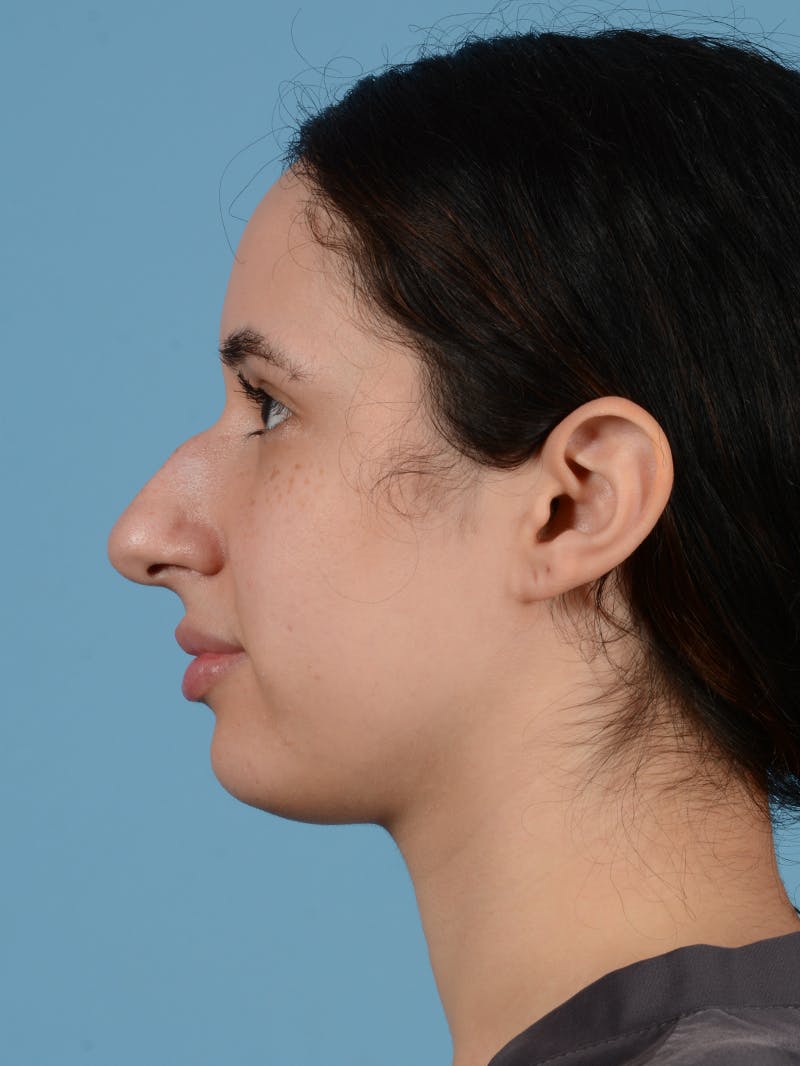 Rhinoplasty Before & After Gallery - Patient 113503767 - Image 5