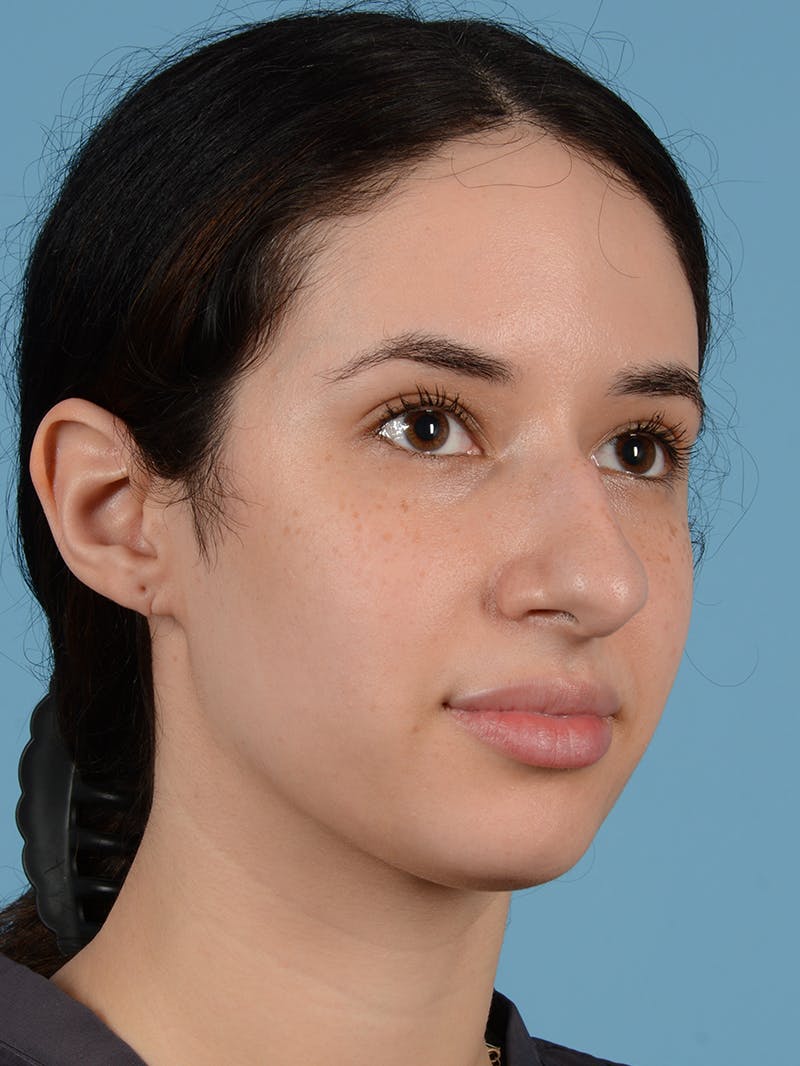 Rhinoplasty Before & After Gallery - Patient 113503767 - Image 3