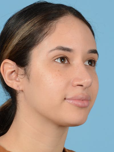 Rhinoplasty Before & After Gallery - Patient 113503767 - Image 4