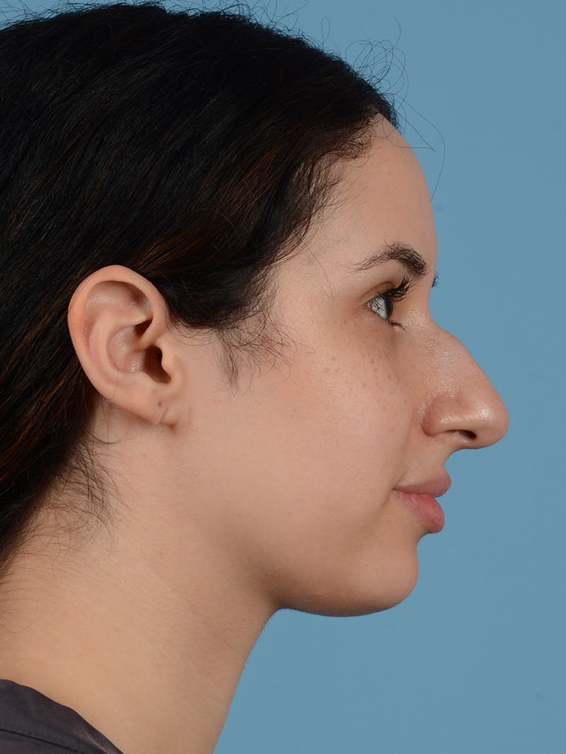 Rhinoplasty Before & After Gallery - Patient 113503767 - Image 1