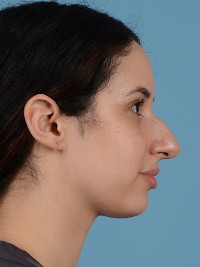 Rhinoplasty Before & After Gallery - Patient 113503767 - Image 1
