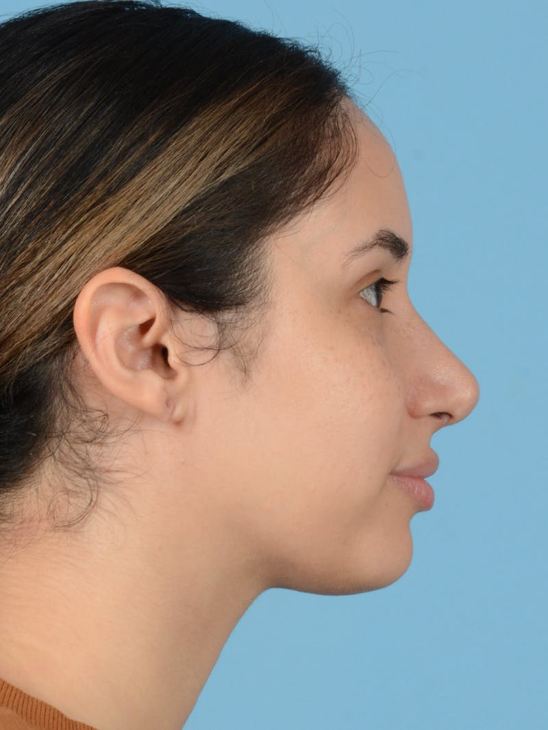 Rhinoplasty Before & After Gallery - Patient 113503767 - Image 2