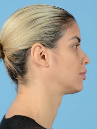 Rhinoplasty Before & After Gallery - Patient 115030746 - Image 1