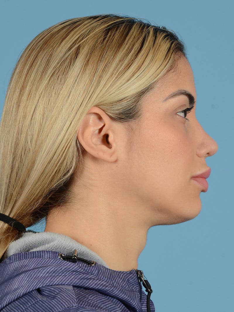 Rhinoplasty Before & After Gallery - Patient 115030746 - Image 2