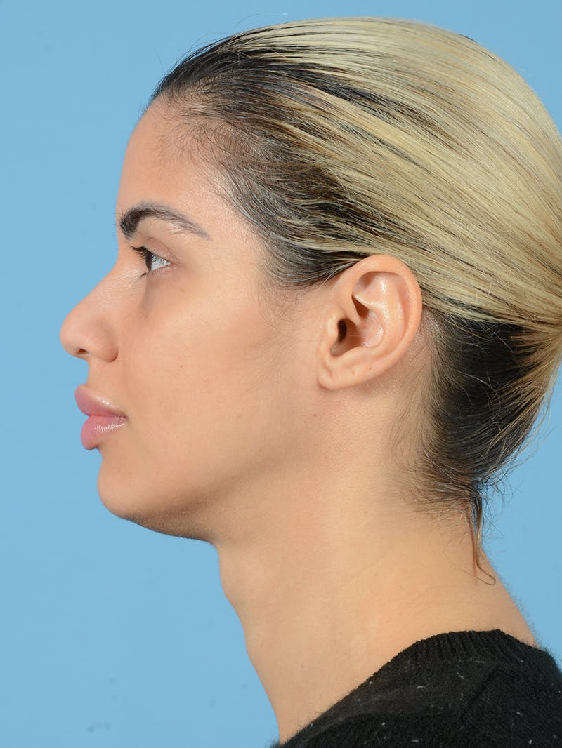 Rhinoplasty Before & After Gallery - Patient 115030746 - Image 3