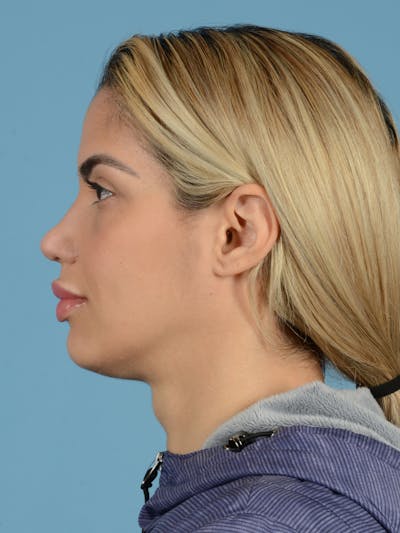 Rhinoplasty Before & After Gallery - Patient 115030746 - Image 4