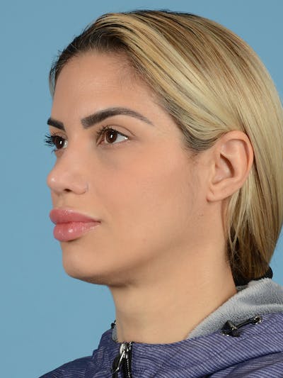 Rhinoplasty Before & After Gallery - Patient 115030746 - Image 6
