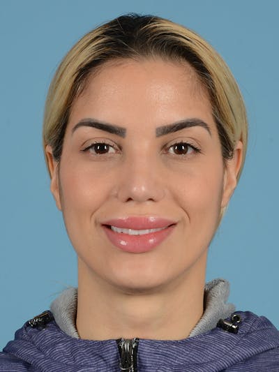 Rhinoplasty Before & After Gallery - Patient 115030746 - Image 8