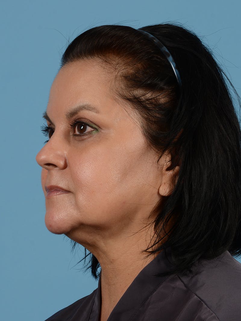 Facelift Before & After Gallery - Patient 115031010 - Image 3