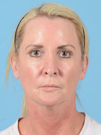 Facelift Before & After Gallery - Patient 115031011 - Image 1