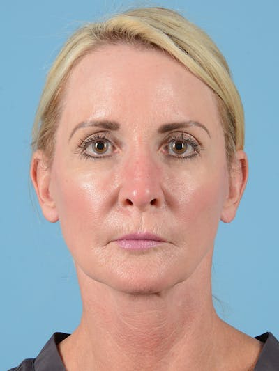 Facelift Before & After Gallery - Patient 115031011 - Image 2