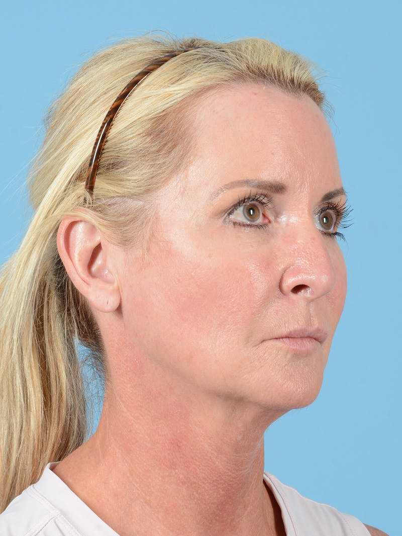 Facelift Before & After Gallery - Patient 115031011 - Image 3