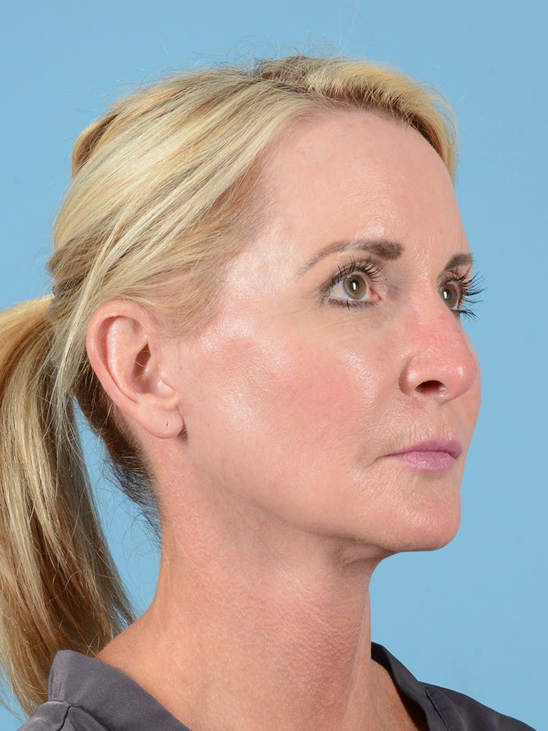 Facelift Before & After Gallery - Patient 115031011 - Image 4