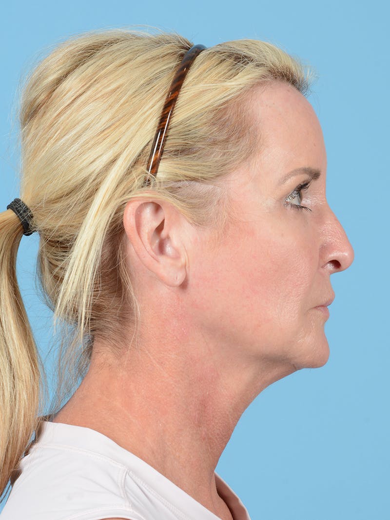 Facelift Before & After Gallery - Patient 115031011 - Image 5