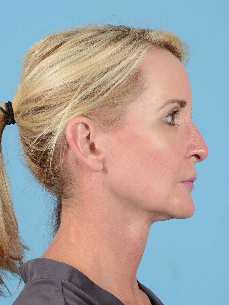 Facelift Before & After Gallery - Patient 115031011 - Image 6