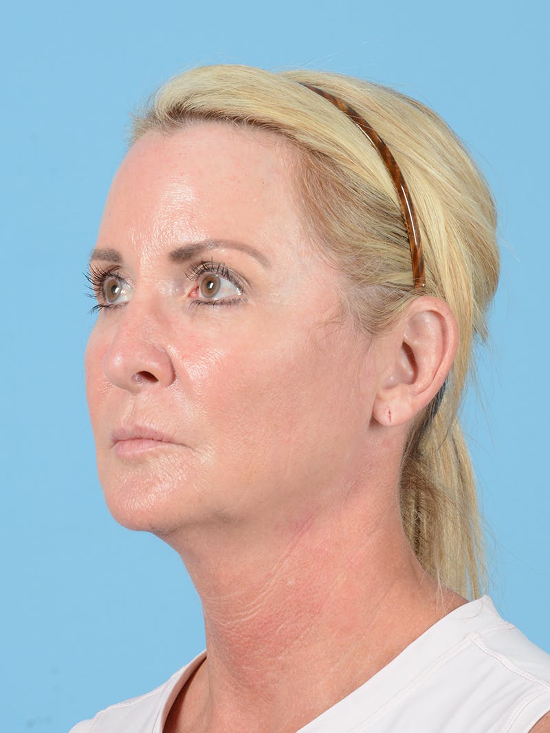 Facelift Before & After Gallery - Patient 115031011 - Image 7