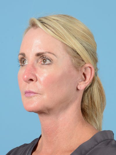 Facelift Before & After Gallery - Patient 115031011 - Image 8