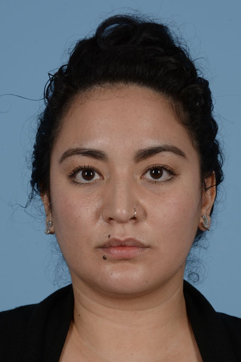 Rhinoplasty Before & After Gallery - Patient 122226443 - Image 3