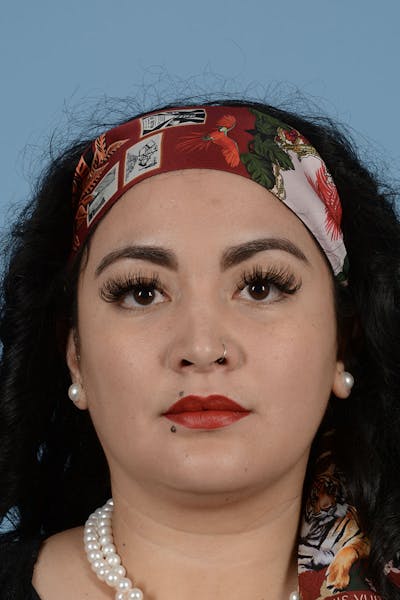 Rhinoplasty Before & After Gallery - Patient 122226443 - Image 4