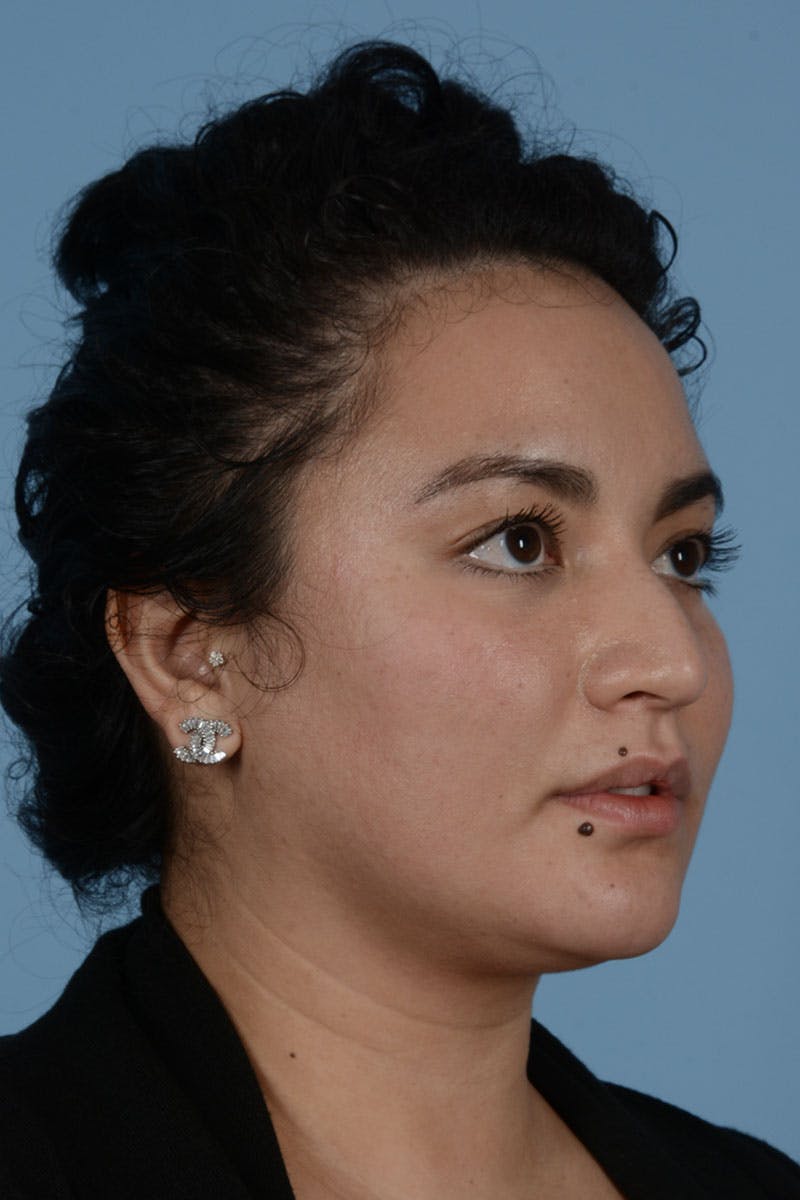 Rhinoplasty Before & After Gallery - Patient 122226443 - Image 5