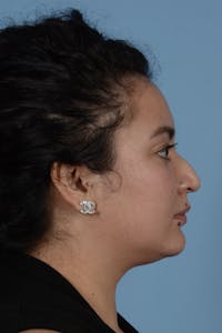 Rhinoplasty Before & After Gallery - Patient 122226443 - Image 1