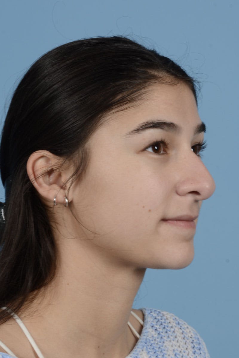 Rhinoplasty Before & After Gallery - Patient 122226450 - Image 3