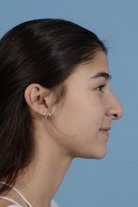 Rhinoplasty Before & After Gallery - Patient 122226450 - Image 1