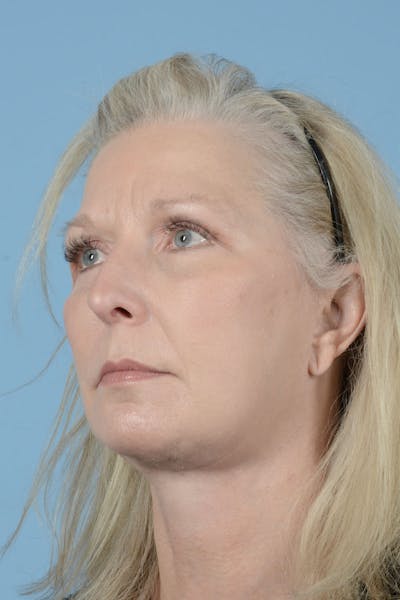 Facelift Before & After Gallery - Patient 122226454 - Image 4