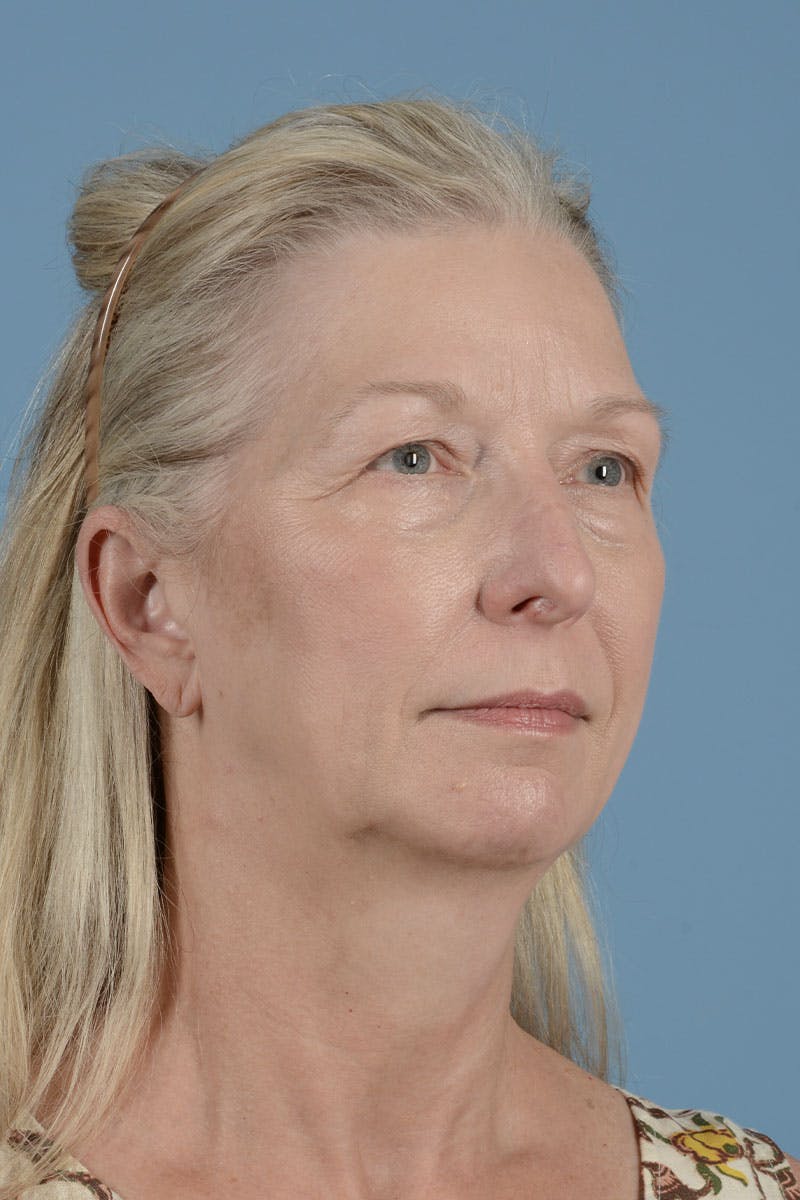 Facelift Before & After Gallery - Patient 122226454 - Image 5
