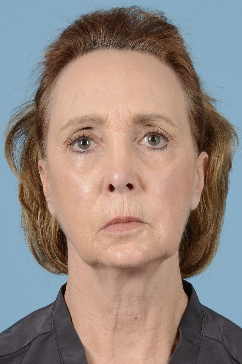 Facelift Before & After Gallery - Patient 122226470 - Image 1