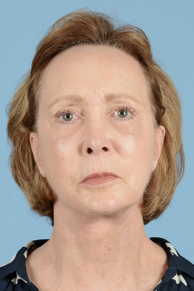 Brow Lift Before & After Gallery - Patient 122226468 - Image 2