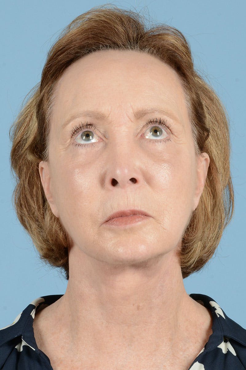 Facelift Before & After Gallery - Patient 122226470 - Image 4