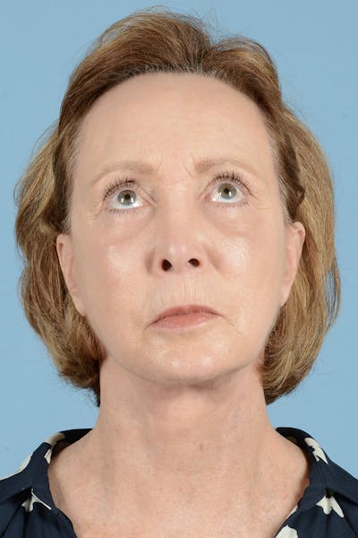 Neck Lift Before & After Gallery - Patient 122226478 - Image 4