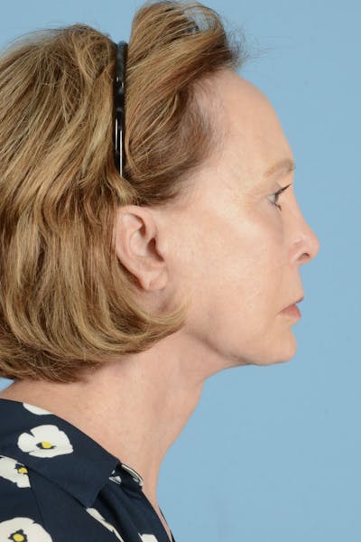 Facelift Before & After Gallery - Patient 122226470 - Image 8