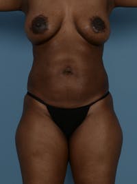 Liposuction Before & After Gallery - Patient 122226537 - Image 1