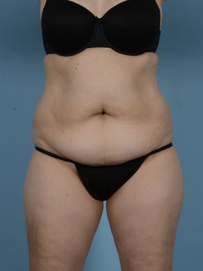 Liposuction Before & After Gallery - Patient 122226547 - Image 1