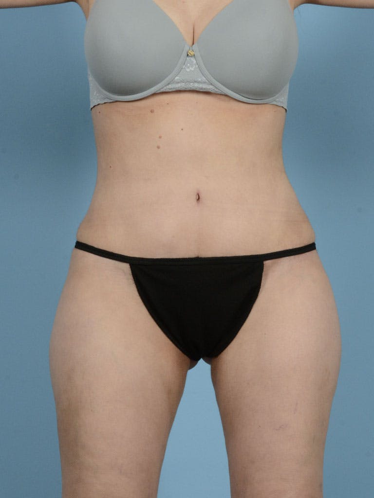 Liposuction Gallery - Patient 122226547 - Image 2