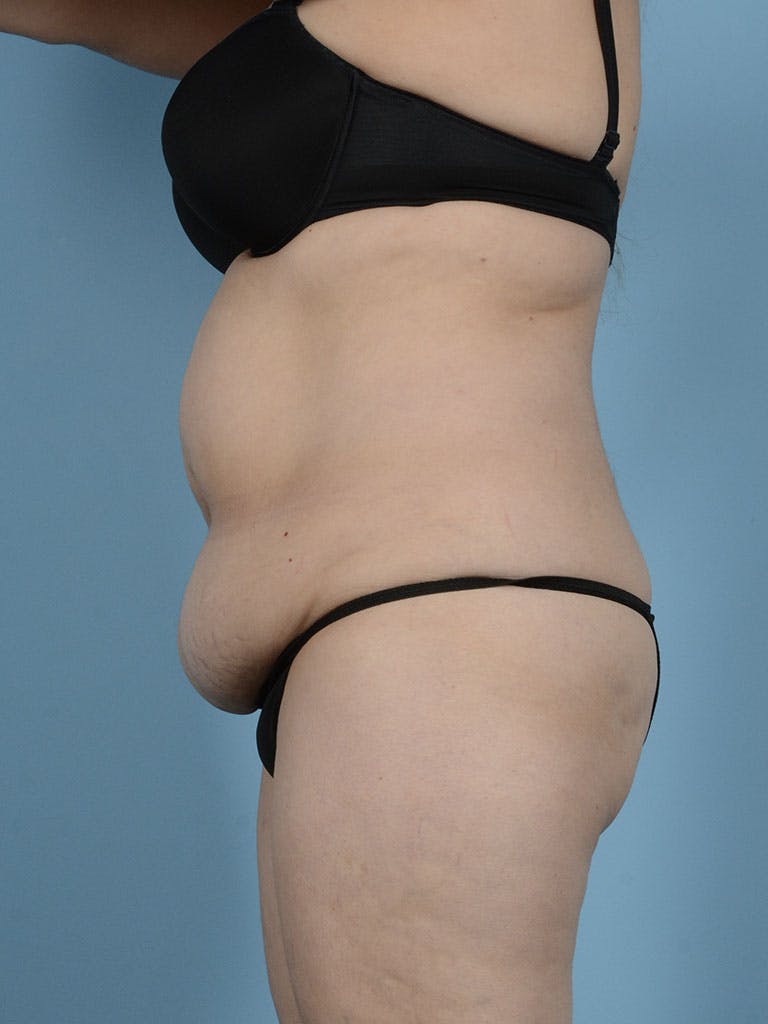 Liposuction Before & After Gallery - Patient 122226547 - Image 5