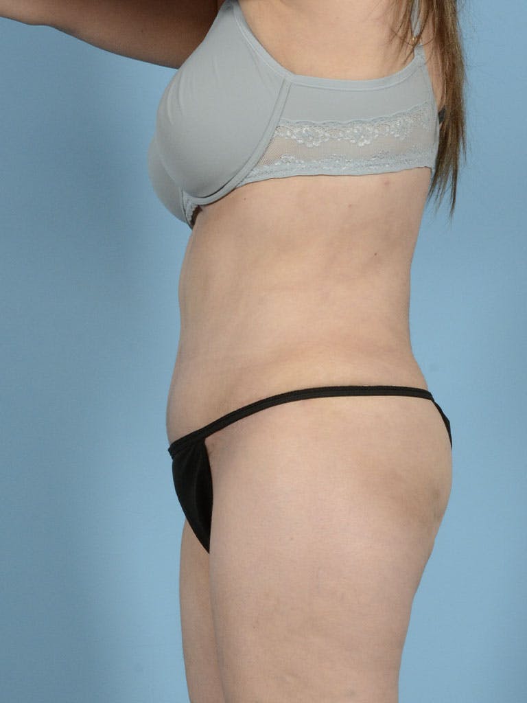 Liposuction Gallery - Patient 122226547 - Image 6