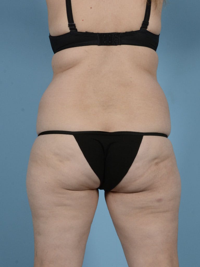 Liposuction Before & After Gallery - Patient 122226547 - Image 7
