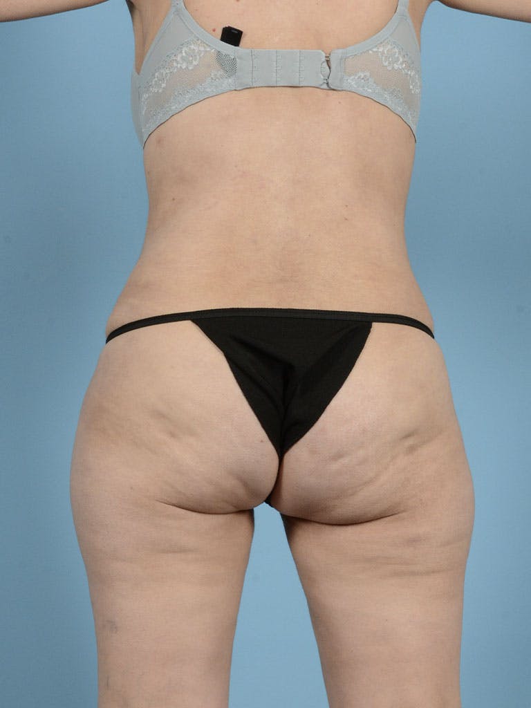 Liposuction Before & After Gallery - Patient 122226547 - Image 8