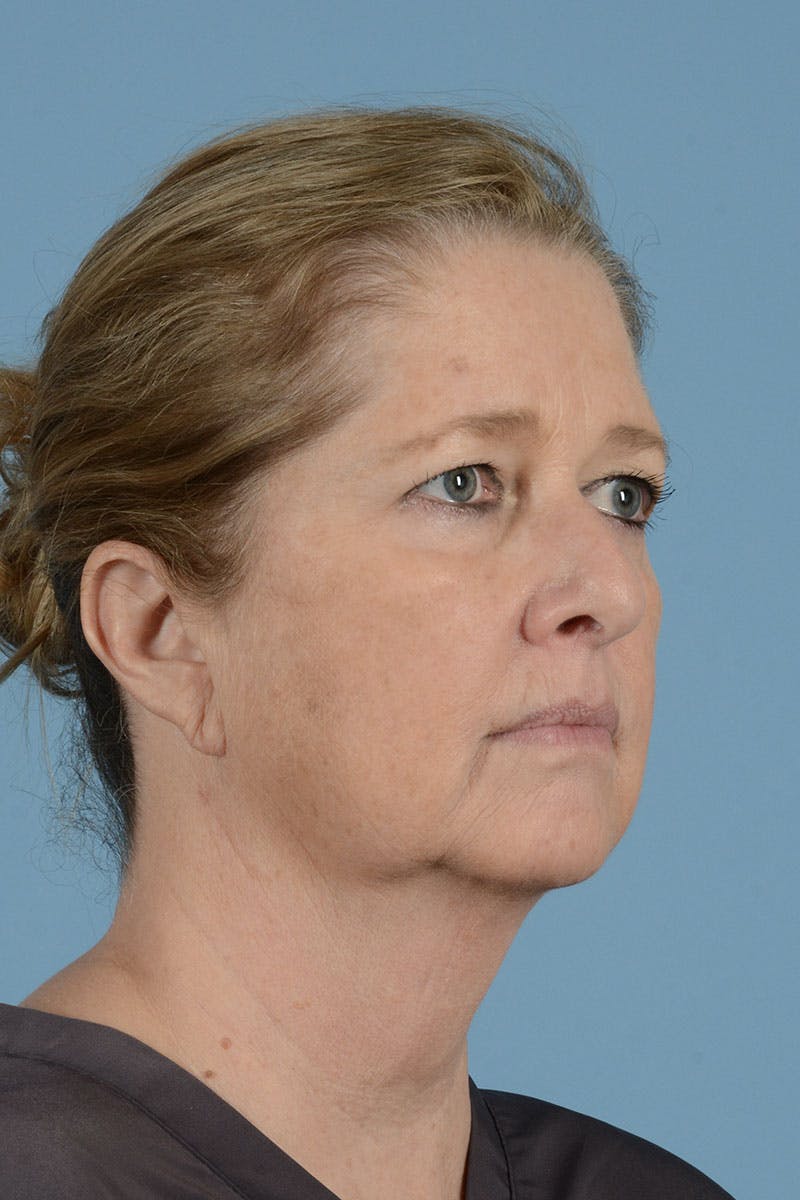 Neck Lift Before & After Gallery - Patient 122226552 - Image 3