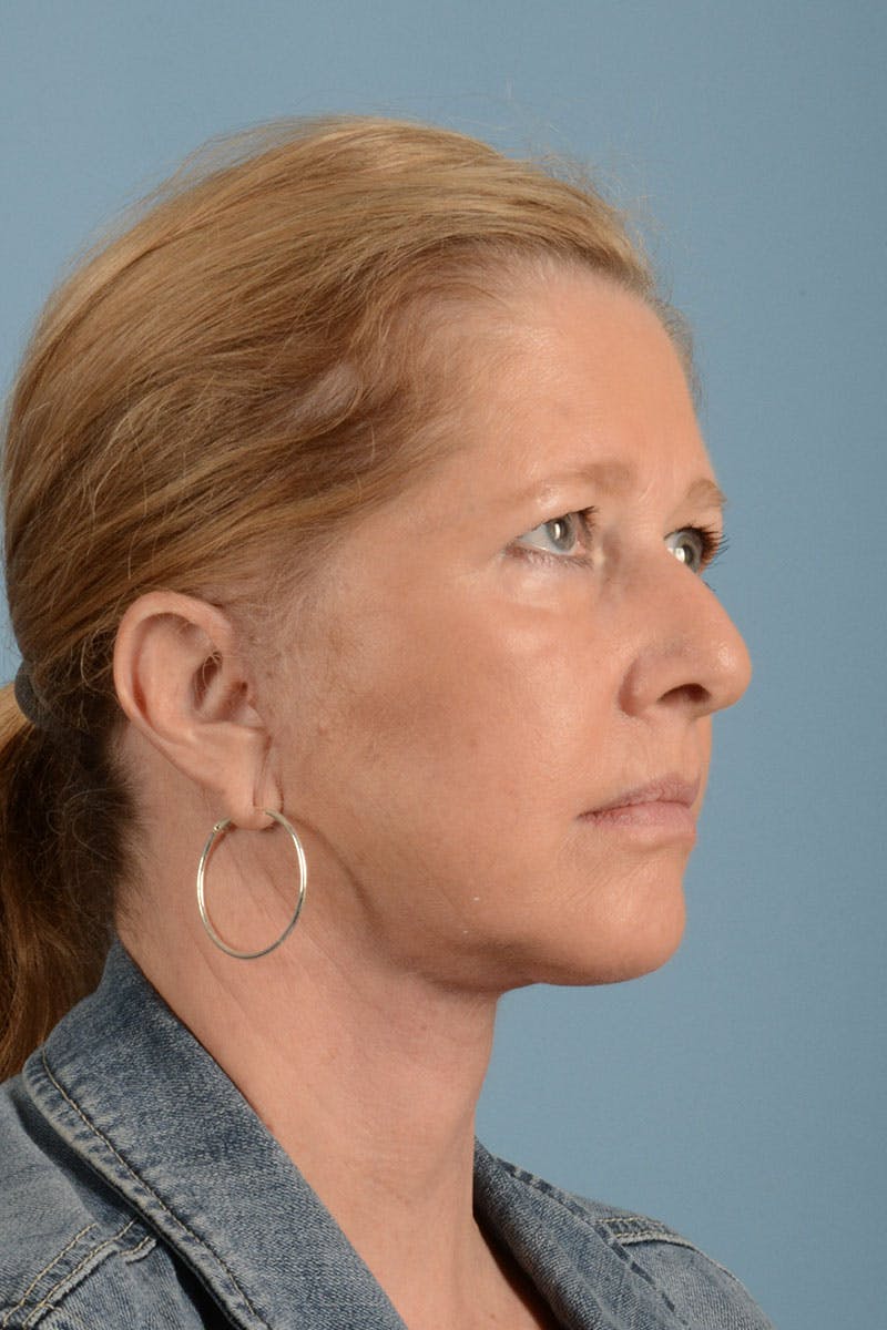 Facelift Before & After Gallery - Patient 122226551 - Image 4