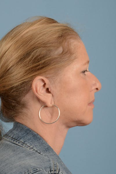 Neck Lift Before & After Gallery - Patient 122226552 - Image 6