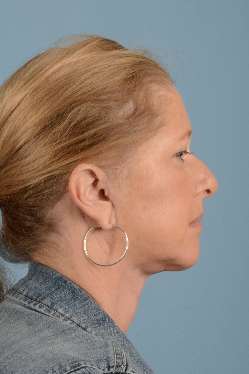 Facelift Before & After Gallery - Patient 122226551 - Image 6