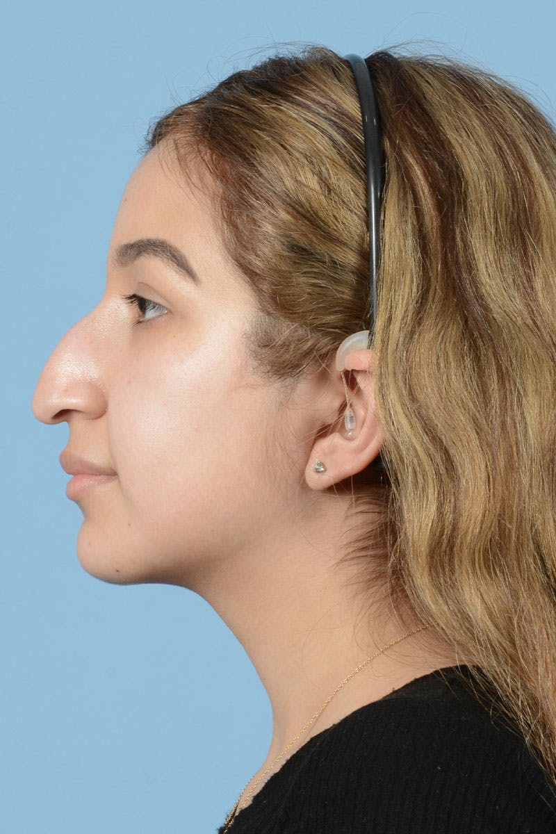 Rhinoplasty Before & After Gallery - Patient 122226555 - Image 5