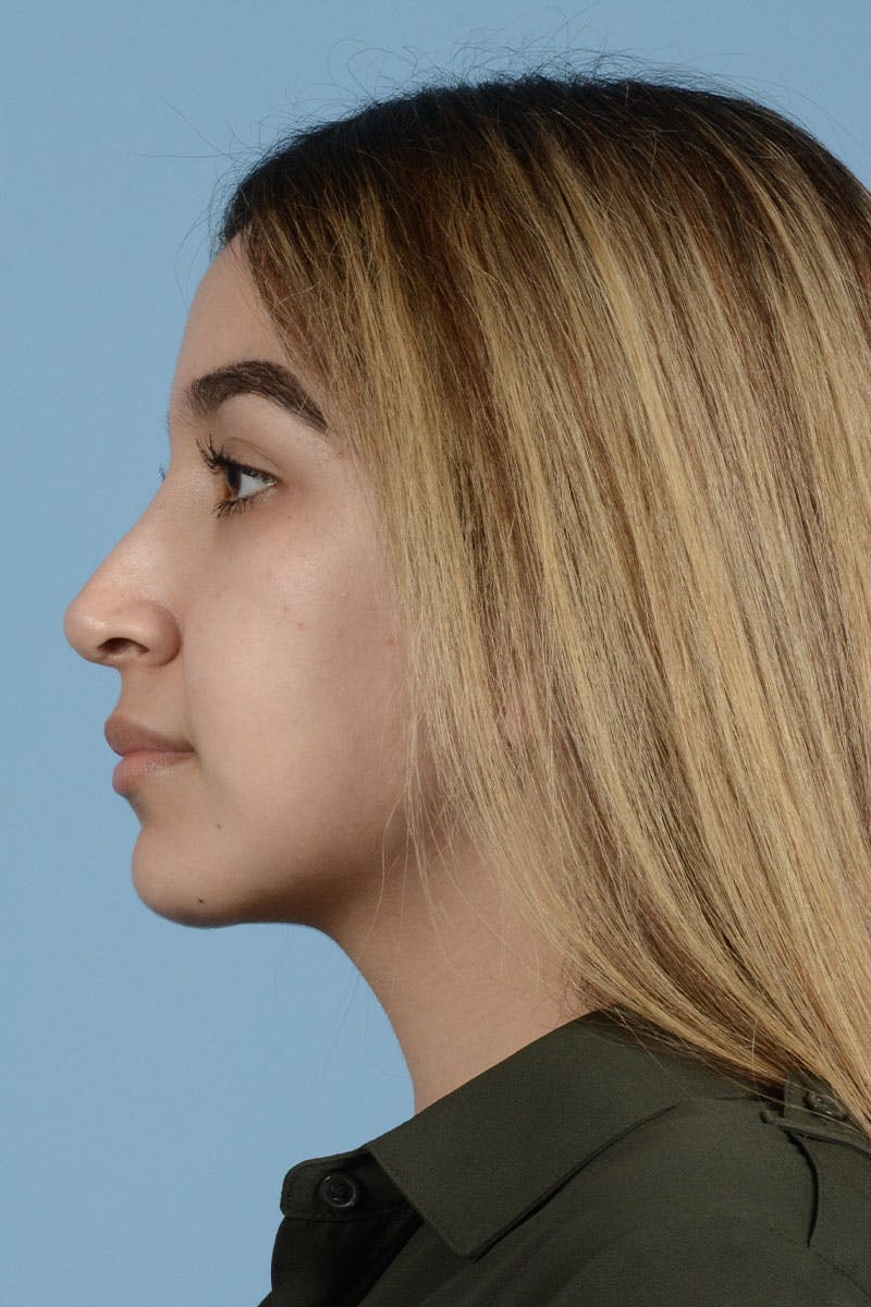 Rhinoplasty Before & After Gallery - Patient 122226555 - Image 6