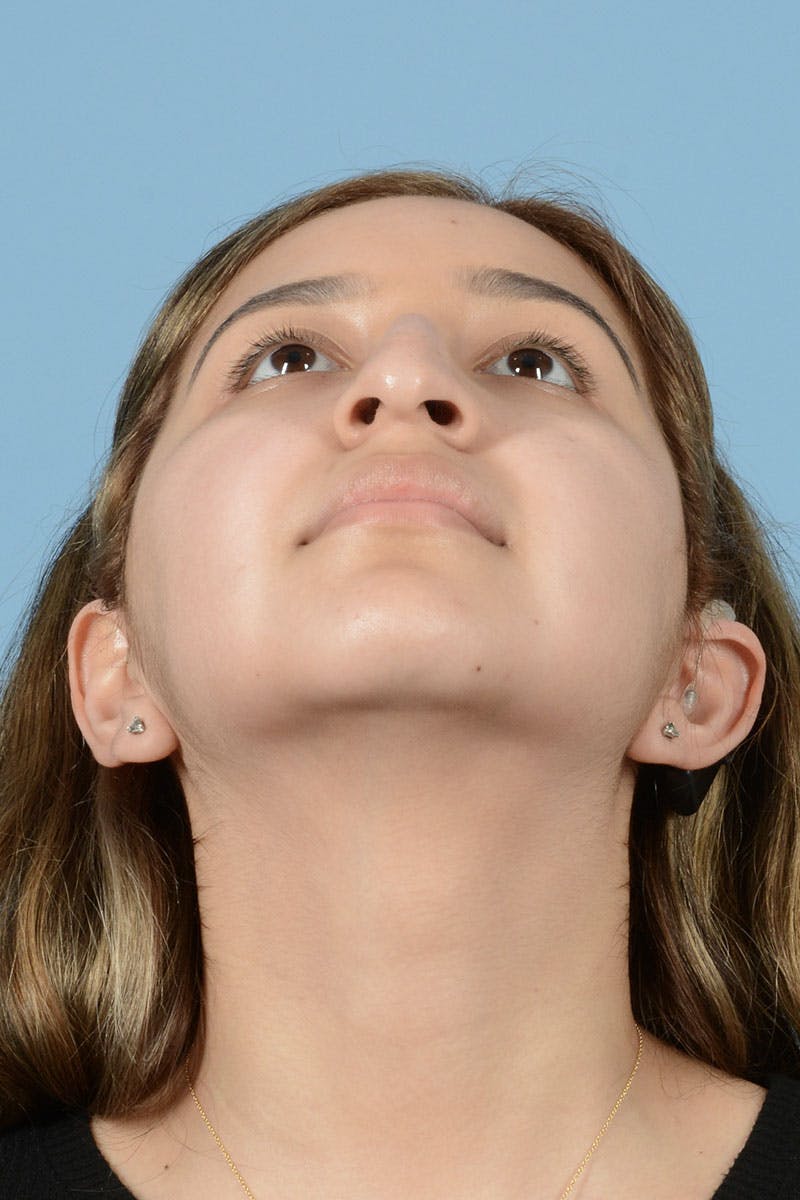 Rhinoplasty Before & After Gallery - Patient 122226555 - Image 7
